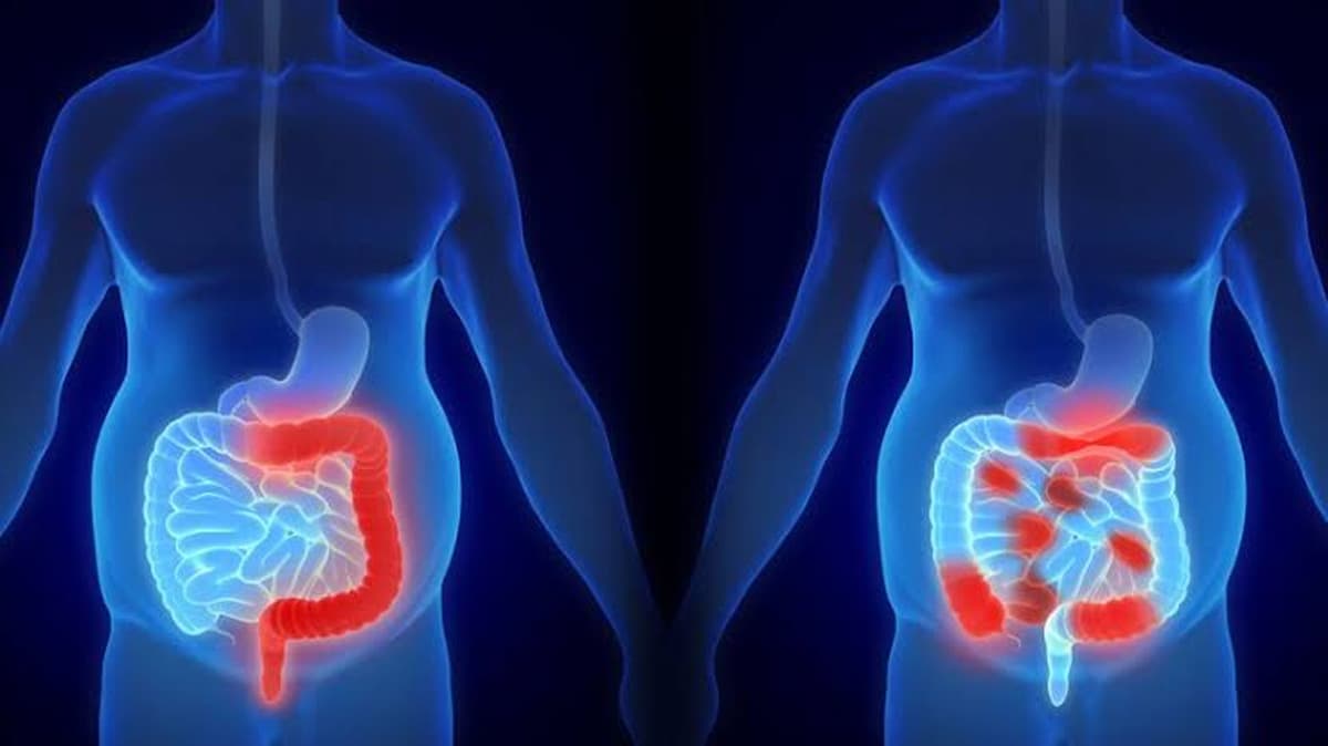 Deteksi Dini Kanker Kolon, Pentingnya Skrining Sejak Usia 45 Tahun - Image