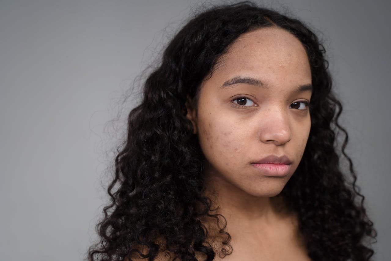 Waspada! Jerawat Bisa Dipicu Polusi dan Sinar UV, Begini Penjelasan Ahli Kulit - Image