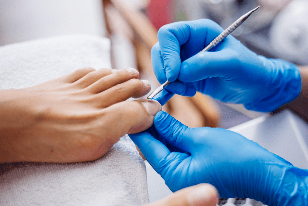 Hati-Hati! Sepatu Kekecilan Bisa Jadi Biang Kerok Cantengan, Kenali Penyebab dan Cara Mengobatinya - Image